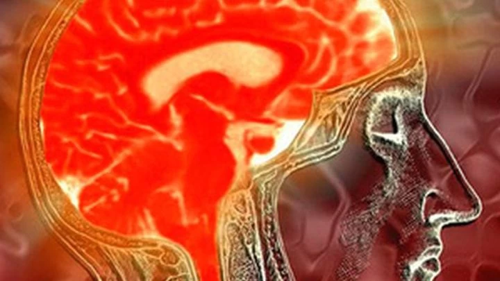 Εγκεφαλικό επεισόδιο: Πότε απειλεί τους νέους;